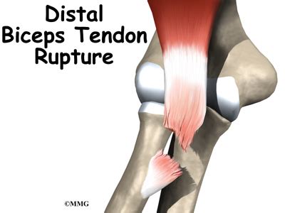 right distal biceps tendon tear